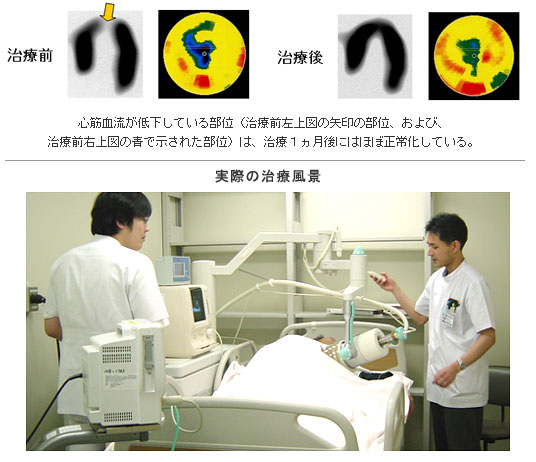 衝撃波治療1