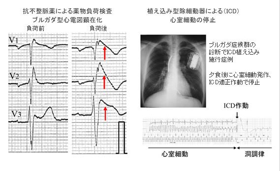 ブルガダ症候群