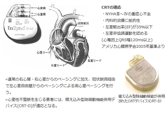 心臓再同期療法1