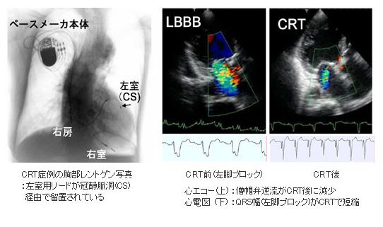 心臓再同期療法2