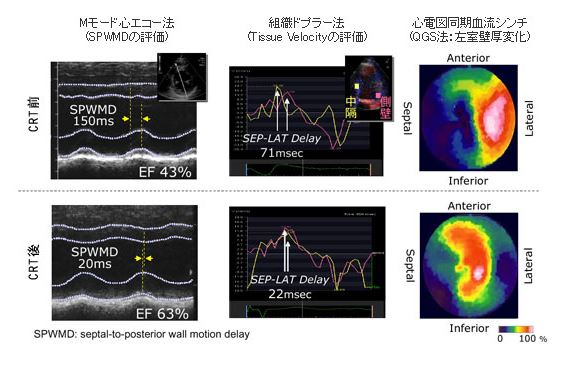 心臓再同期療法3