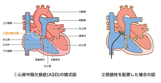 ASD1