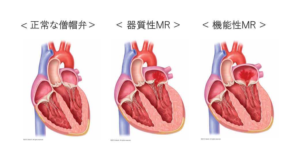 器質性と機能性MR