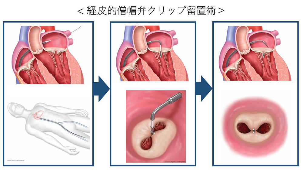 経皮的僧帽弁クリップ術